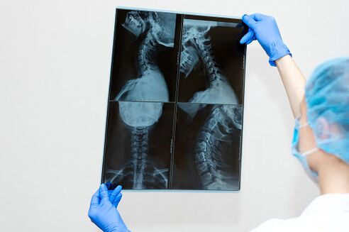Osteochondrosis of spinal disease