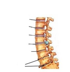 stage of development of osteochondrosis