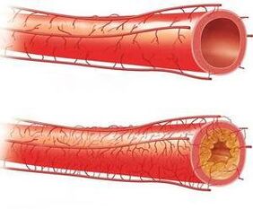 Ordinary vessels and with poor patency with extended levels of cervical osteochondrosis