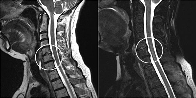 Cervical osteochondrosis on x-ray