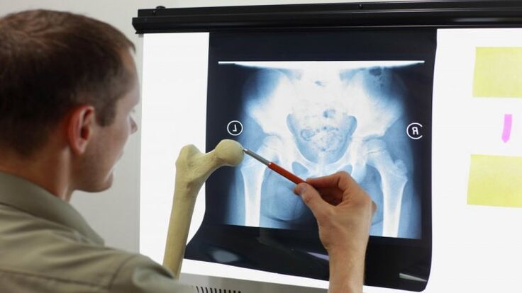 The doctor examines the x-ray for hip arthrosis